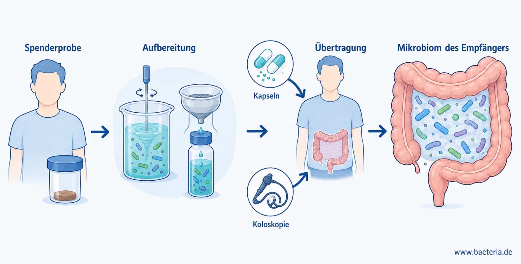 Wie funktioniert eine Fäkalmikrobiotatransplantation (FMT)?